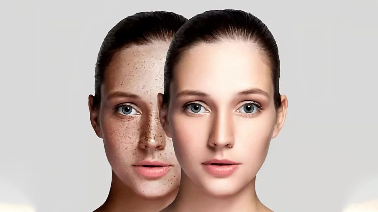 Skin Pigmentation? Here’s How You Can Treat Through Ayurveda
