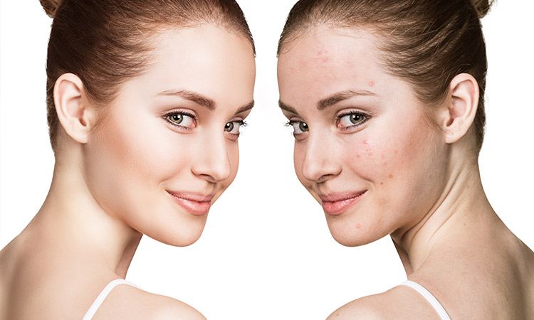 SAY GOODBYE TO ACNE EFFECTIVELY
