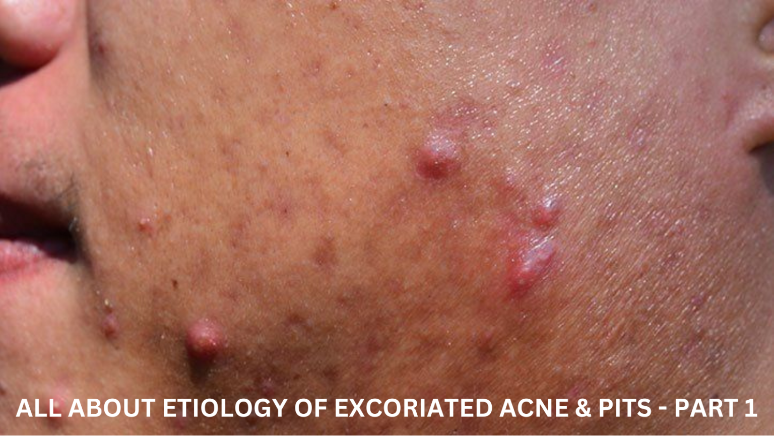 ALL ABOUT ETIOLOGY OF EXCORIATED ACNE & PITS – PART 1