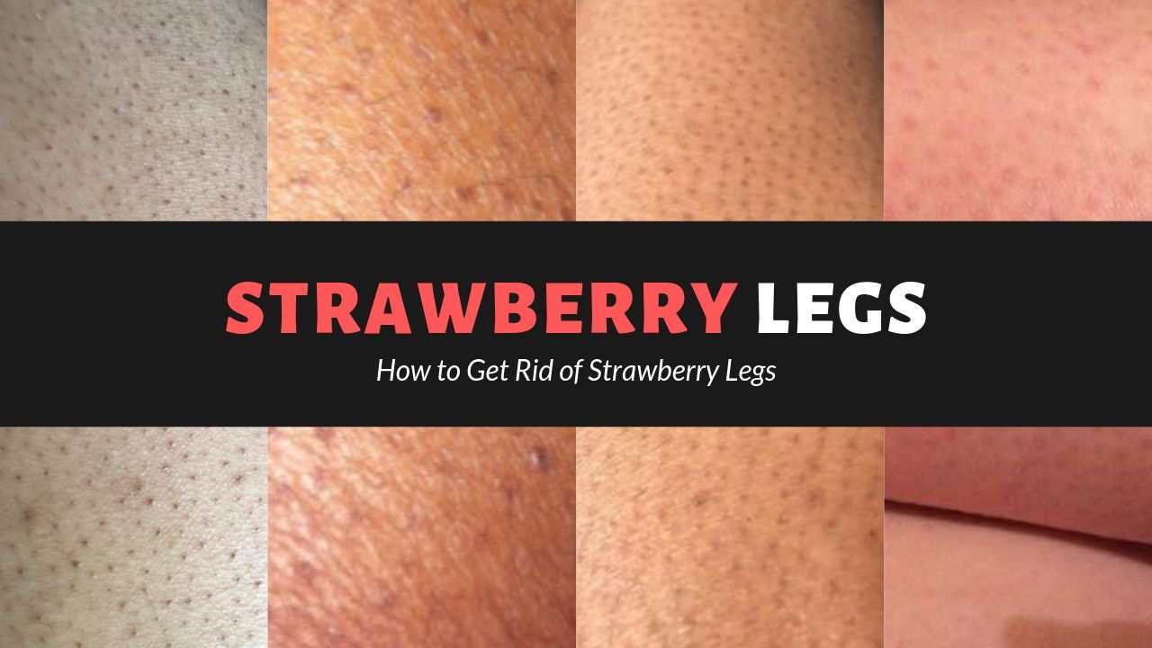 Strawberry Legs: How To Prevent & Treat Them?