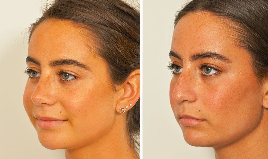 Rosacea & Bulbous Nose- Etiology & Treatment…