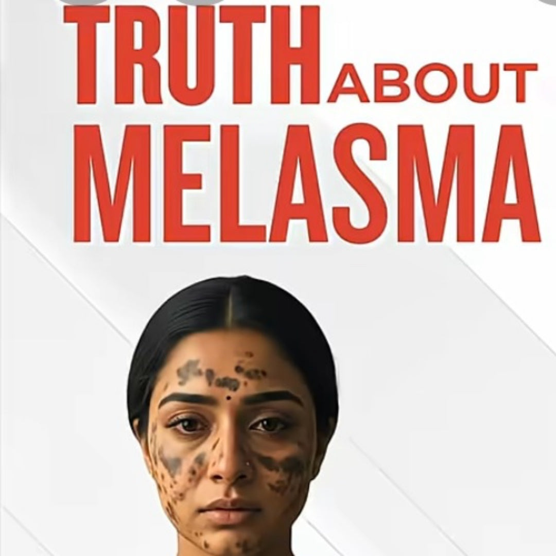 Melasma Treatment Truth: What You Must Know Before Starting Treatment